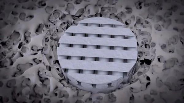 新型生物玻璃可望修复部分软骨组织