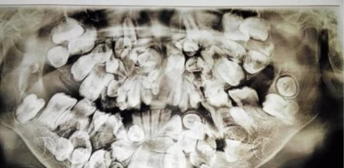 菲律宾男孩患多齿症长300颗牙齿 已拔40颗(图)